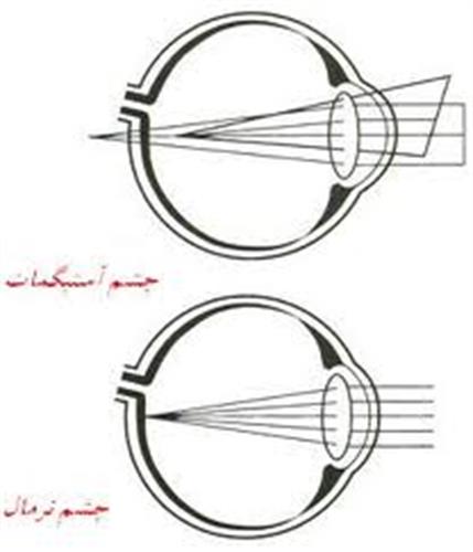 آستیگماتیسم